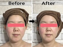 ハニー(Honey82)/小顔姿勢コルギ　比較写真