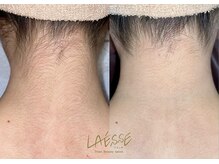 ラエッセ(LAESSE)/〔レディース〕うなじ脱毛