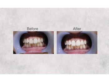 ミセル 尾道店(MYTHEL)/before　after　ホワイトニング