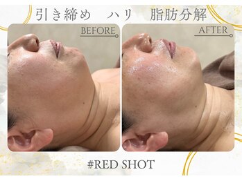 ナチュールファースト(naturel first)の写真/【人気急上昇!RED SHOT小顔フェイシャル!】
ダウンタイムが無く、脂肪分解と肌育のWアプローチ
