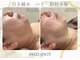 ナチュールファースト(naturel first)の写真/【人気急上昇!RED SHOT小顔フェイシャル!】
ダウンタイムが無く、脂肪分解と肌育のWアプローチ