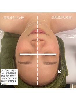 フォルチェ 春日(Folche)/小顔フェイシャル☆