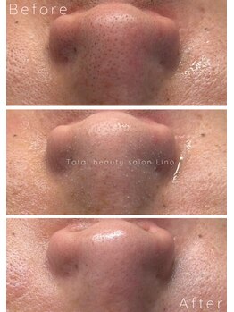 リノ(Lino)/BeforeAfter