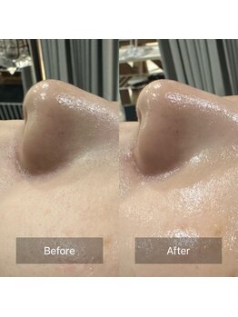 ケアナ 梅田店(CareNa)/ツヤ肌毛穴洗浄★ヒト由来幹細胞