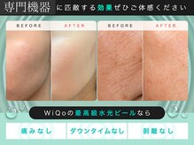 フットミー(foot mii)/ほうれい線も即日ケア