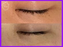 ハーブピーリング 名古屋/シミ改善には光ピール☆