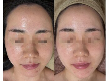 aura.まつげ・ハーブピーリング専門店/ハーブピーリング3回での変化