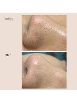 キッキー(Kicky)/毛穴洗浄（before＆after）