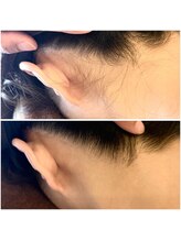 スノーフレーク(snow flake)/ブライダルシェービング◇症例◇