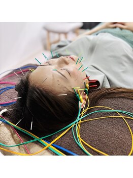 フラット(flat)/施術風景/小顔美容鍼