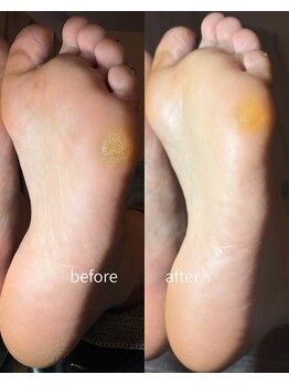 オリジン(Origin)/韓国式足裏角質ケア