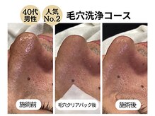 グラツィア(Grazia)/毛穴洗浄コース