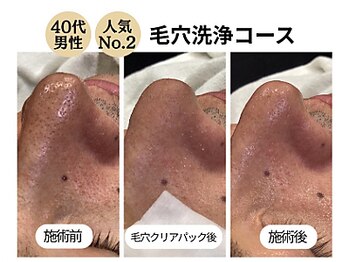 グラツィア(Grazia)/毛穴洗浄コース