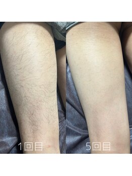 カナウ(KANAU)/脚脱毛（20代前半男性）