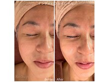 ヒーリングサプリ(Healing Supple)の雰囲気（インディバフェイシャルではむくみスッキリ！肌密度アップ！）