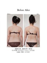 エキュレ ジャーニー トゥ マイ トータル ビューティー(equrer)/RFマシンを使った痩身ケア