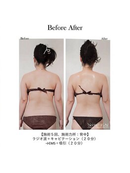 エキュレ ジャーニー トゥ マイ トータル ビューティー(equrer)/RFマシンを使った痩身ケア