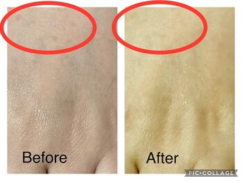 アンフィー 川西能勢口店(Une f`ee)/手のシミケアBefore,After★