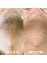 バロン/ヒゲ脱毛効果2