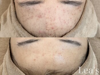 レアース(Lea's)/剥けないピーリング