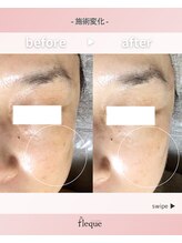 フレク(fleque)/くすみやシミケアにはこちら