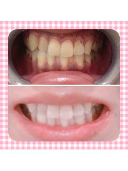 カシワビューティーココ(kashiwa beauty coco)/セルフホワイトニング