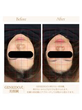 げんき堂整体院 ララガーデン長町店/【刺さない美容鍼】美顔鍼