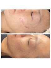 プルメリア(Plumeria)/スヴェイルスキンニキビ効果２