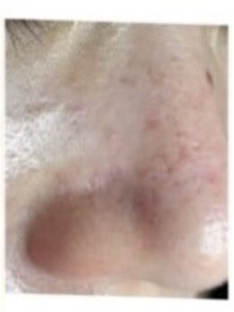 毛穴ケアをしたい