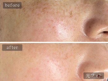 アムールサロン(Amour salon)/光フェイシャルでシミケア/新宿