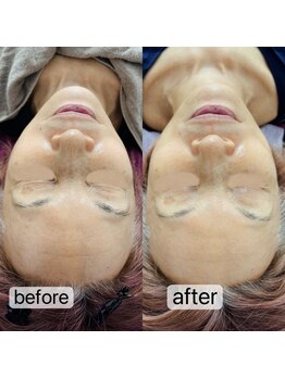 トゥインクル(Twinkle)/瞼のたるみも・・・