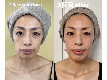 ソマティックチェンジ 麻布十番店(Somatic Change)/セルラム施術前後