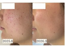 アエオボンヌール(A.E.O BONHEUR)の雰囲気(体内環境の整え、お肌の修復力を高めて繰り返すニキビ卒業へ)