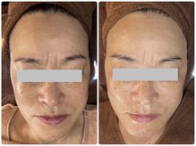 キレイ(KIREI)/before　＆　after