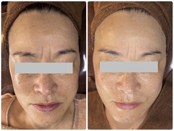 キレイ(KIREI)/before　＆　after