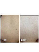 パルティノ 高崎店/【症例】背中脱毛☆２回目☆