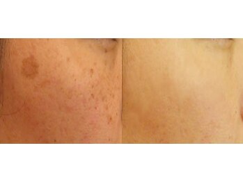 パウザ(PAUSA)/フォトRFフラクショナル