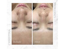 シャルムパリス(charme paris)/敏感肌の方も◎１回の施術変化