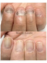 マリーロール 梅田店(Marie Laure)/自爪育成/深爪矯正/ネイルケア