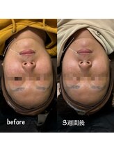 ミヨン(Miyong)/3週間後もリフトアップ持続/小顔