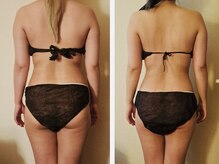 マナ(mana)/オーダー痩身コース１か月半経過