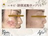 【ニキビケア毛穴】集中メゾット顔・ボディにも施術可　体験クーポン