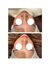 アデル 久留米(ADEL)/毛穴ケア