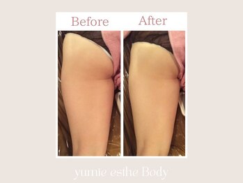 トータルビューティー ゆみえエステ(Total Beauty)/痩身/ハイパーナイフ お尻・足