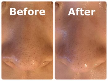 スイ 昭島店(Sui)/ハーブピーリング/毛穴ケア/美白