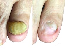 ルーム ノヘア(Room nohea)/自分では切れない【肥厚爪】