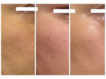 ルビー(RUBY)/プラズマ×幹細胞導入