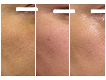 ルビー(RUBY)/プラズマ×幹細胞導入