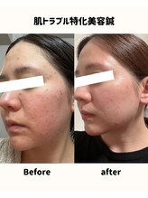 ルポ 那覇(repos)/肌トラブル特化美容鍼