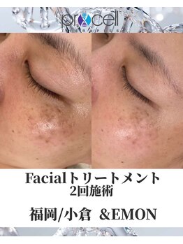 アンドエモン(&EMON)/【お顔】プロセル効果